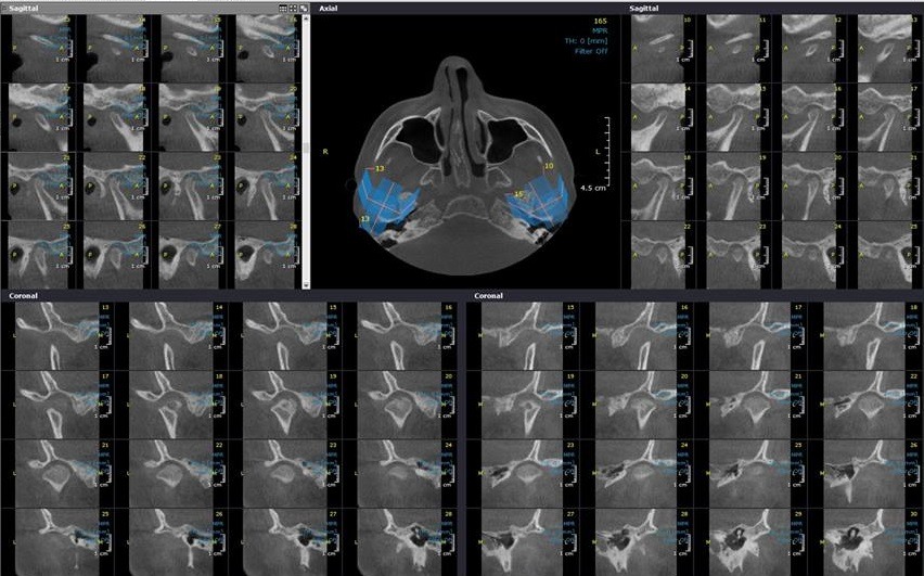 Temporomandibuler Eklem CBCT